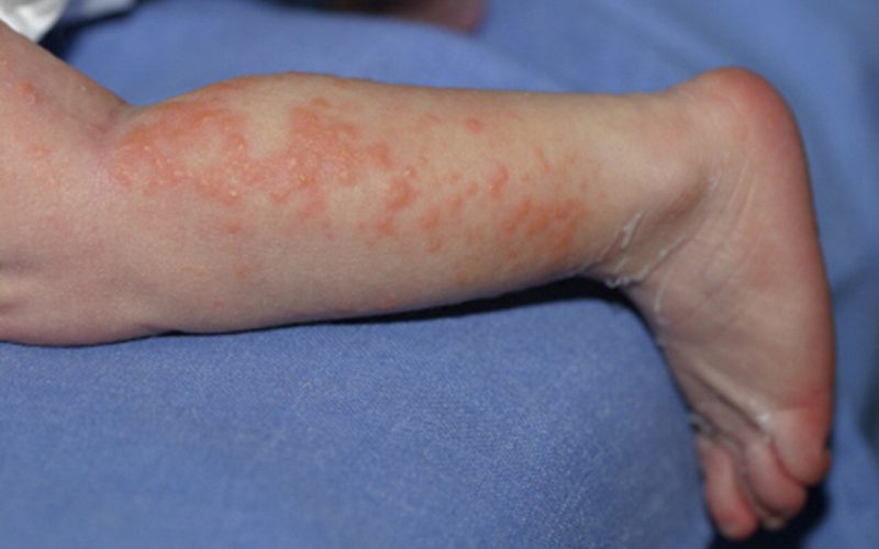 Genodermatosis - Casa Pediátrica