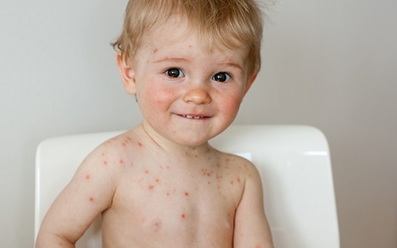 La importancia de prevenir la varicela - Casa Pediátrica