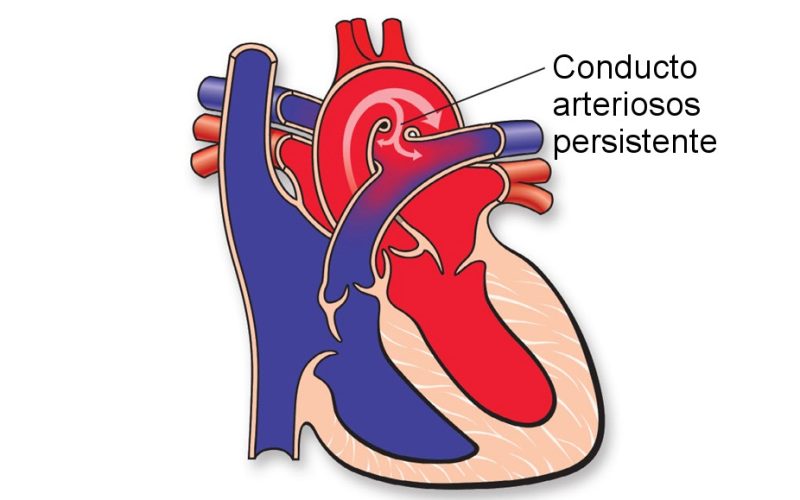 Persistencia del Conducto Arterioso - Casa Pediátrica