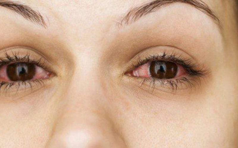 Alergia Ocular - Casa Pediátrica