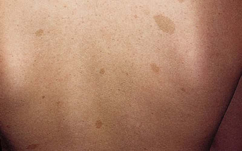 Neurofibromatosis tipo 1. - Casa Pediátrica