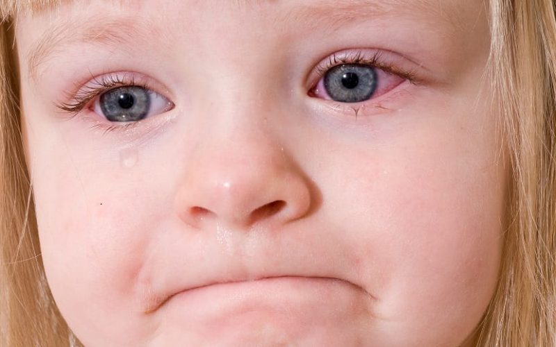 Conjuntivitis - Casa Pediátrica